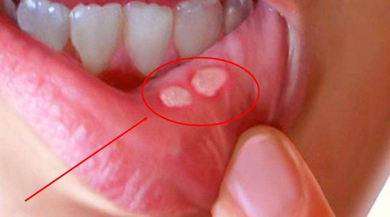 Герпетический стоматит: как определить, способы лечения - много зубов
