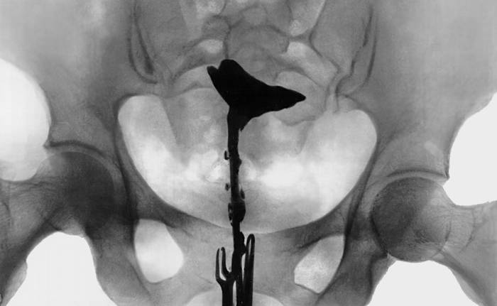 Непроходимость маточных труб: симптомы, причины, лечение