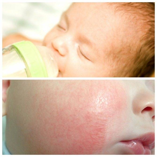 Аллергия на глютен – что нельзя есть, а что можно (список)? непереносимость глютена у детей и взрослых | gastrogid.ru