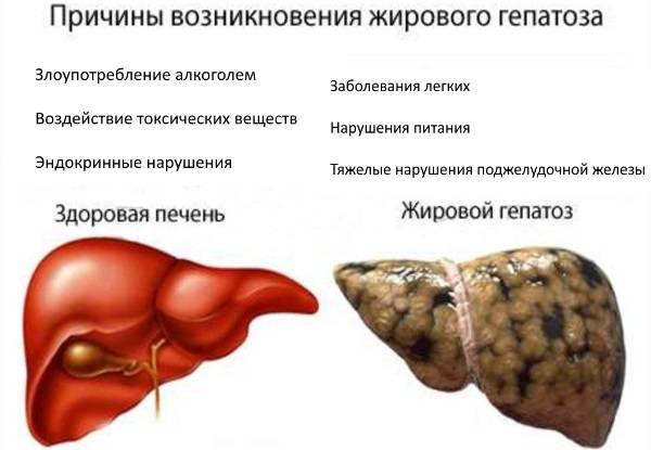 Стеатоз печени (гепатоз): симптомы, лечение и диета при жировом гепатозе