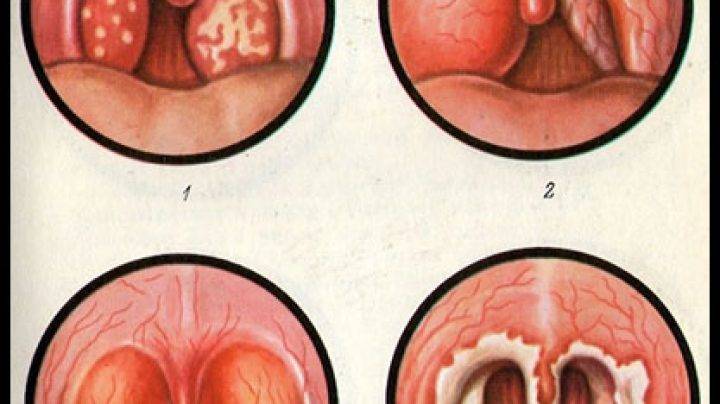 Герпесная ангина у детей (19 фото): симптомы и лечение герпетической формы, симптомы, как выглядит