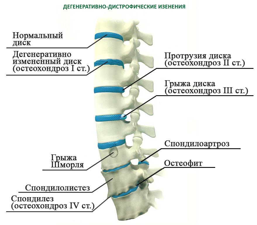 Диффузно дегенеративные