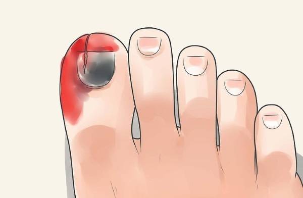 Отслоение ногтя на ноге: причины и методы решения проблемы