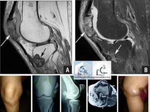 Мрт колена: подготовка и что покажет диагностика