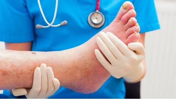 Признаки и лечение гангрены ноги при сахарном диабете на начальной стадии и последующих