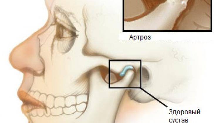 Боль при открывании рта в челюсти возле уха с левой и правой стороны: причины