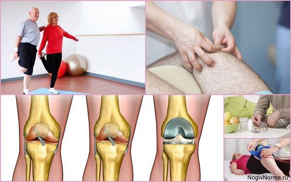 Гонартроз 1 степени коленного сустава: лечение препаратами, физиопроцедурами, массажем, народными средствами