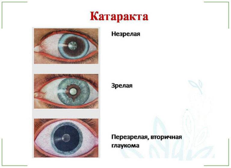 Лечение катаракты без операции лекарственными средствами и народными