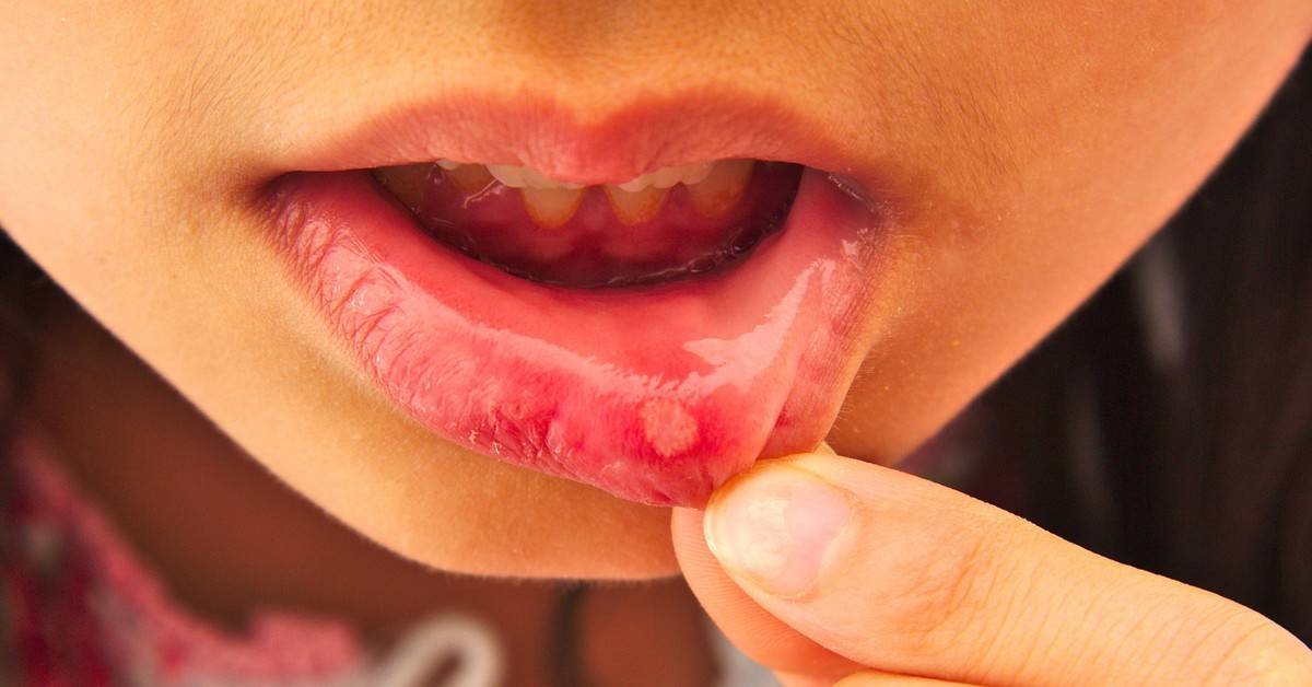 Чем лечить стоматит у взрослых во рту: симптомы, лечение, фото