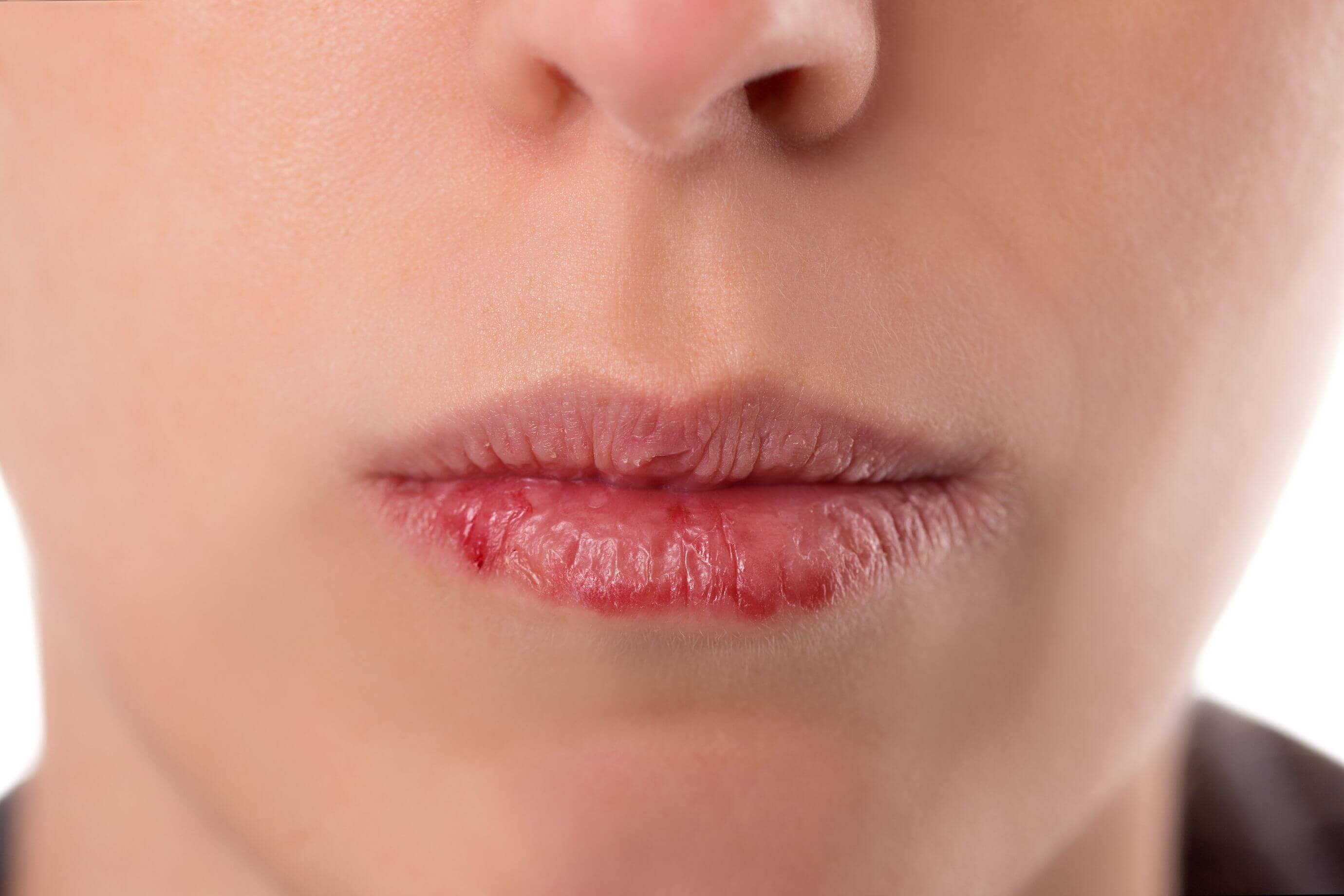 Трещины в уголках губ: почему появляются и что делать?
