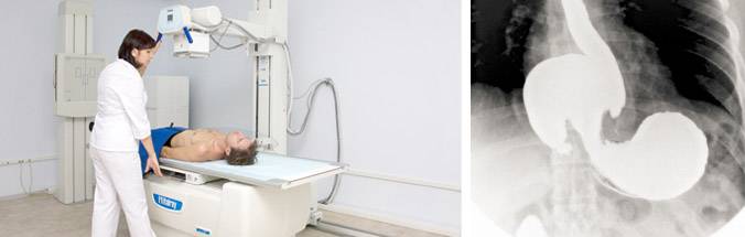 Рентген кишечника, желудка и пищевода: что показывает рентгеноскопия, как ее делают