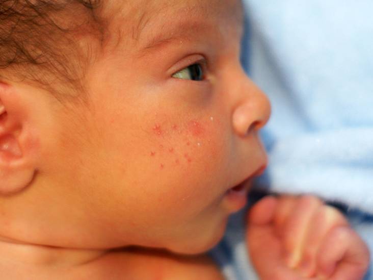 Фурункул у ребенка (22 фото): причины и лечение чирея на ягодицах, ноге и руке, гнойник в носу у новорожденных и грудничков