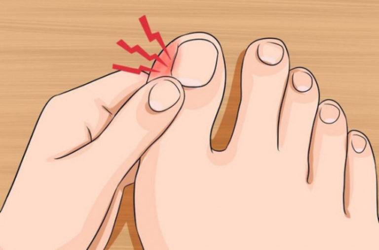 Причины и лечение острой боли в суставах большого пальца ноги