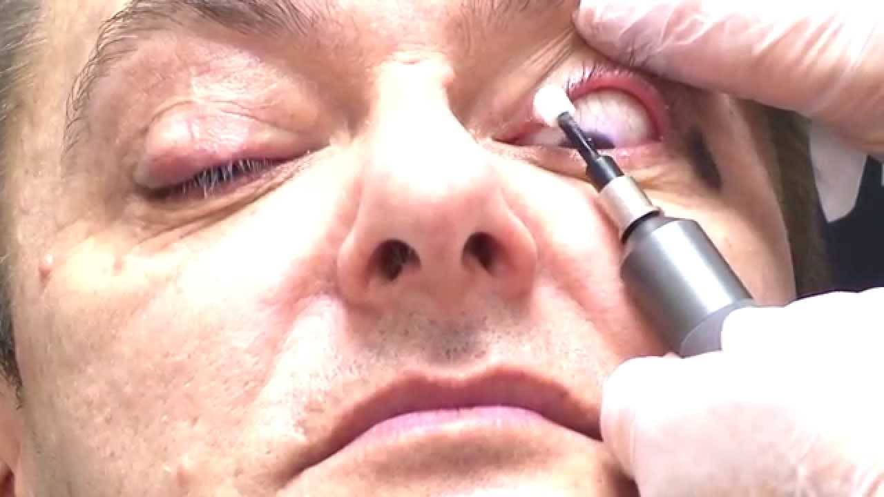 Как производить лечение демодекоза век, ресниц и кожи вокруг глаз