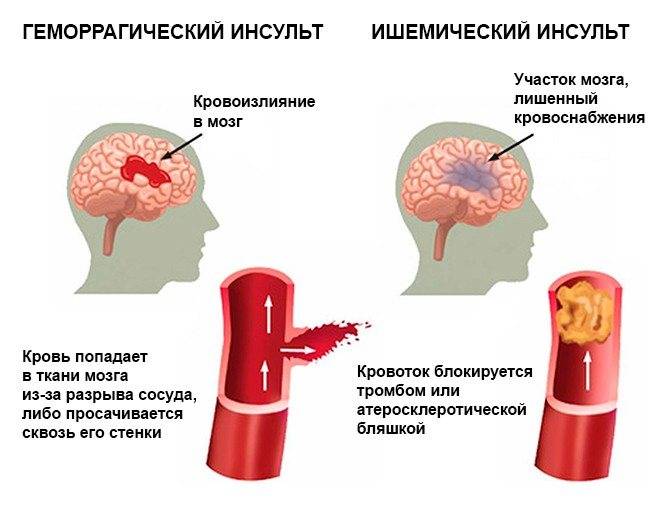 Анализ крови на мозг. ОНМК геморрагический инсульт клиника. Геморрагический инсульт разрыв сосуда. Кровоизлияние в ствол головного мозга ишемический инсульт. Тромботический ишемический инсульт.