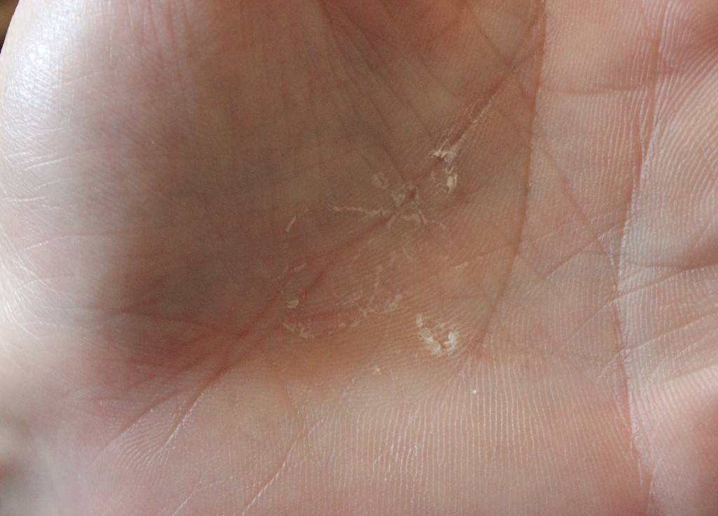 Шелушится кожа между пальцами рук: фото, возможные болезни, лечение | заболевания кожи