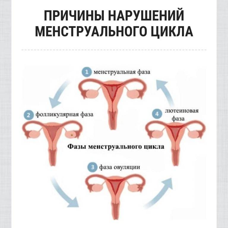 Причины и лечение нарушения менструального цикла