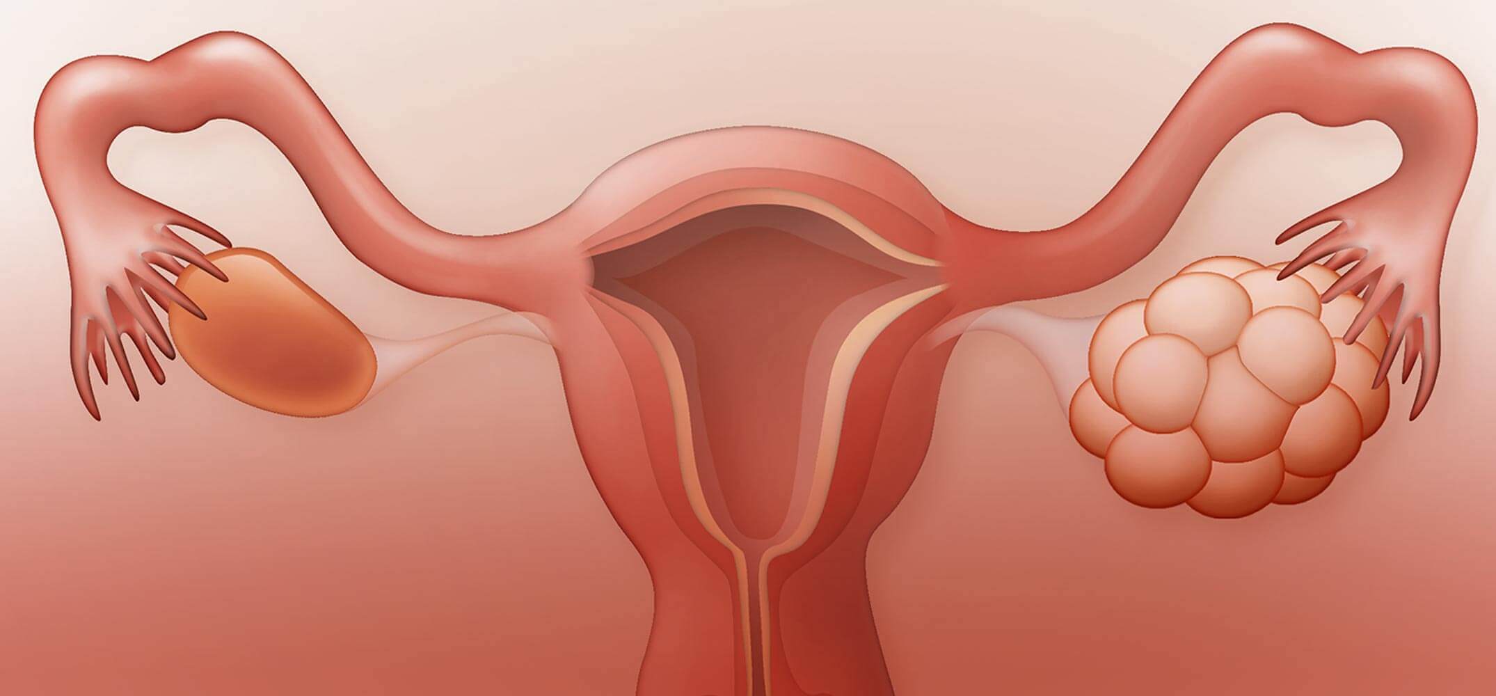 Дисфункция яичников - что нужно знать женщине о недуге