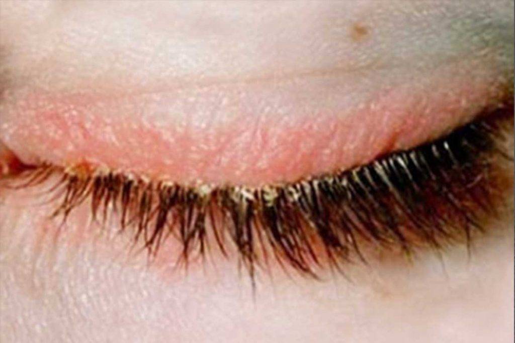 Клещ демодекс: веки, ресницы, кожа вокруг глаз, препараты для лечения