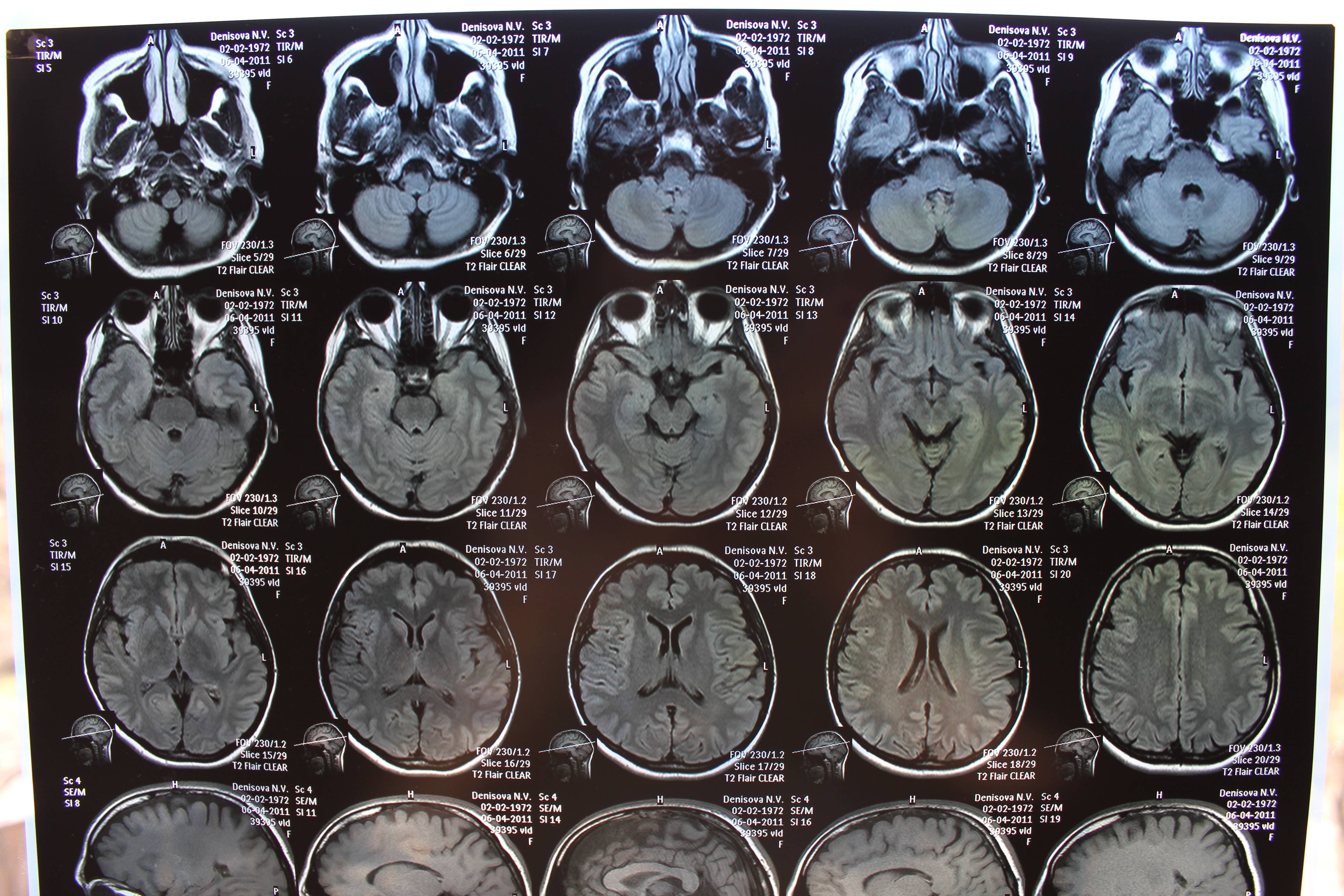 Мрт головного мозга в центре. Снимок мрт мозга здорового человека. Снимки мрт головного мозга здорового человека. Компьютерная томография кт головного мозга. Мрт головного мозга человека в норме.