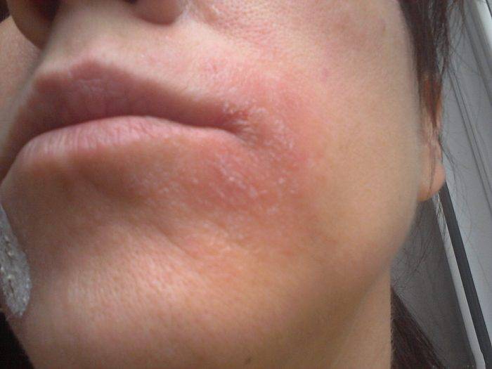 Покраснение вокруг рта, шелушение кожи у взрослого и ребенка: причины и лечение | fr-dc.ru