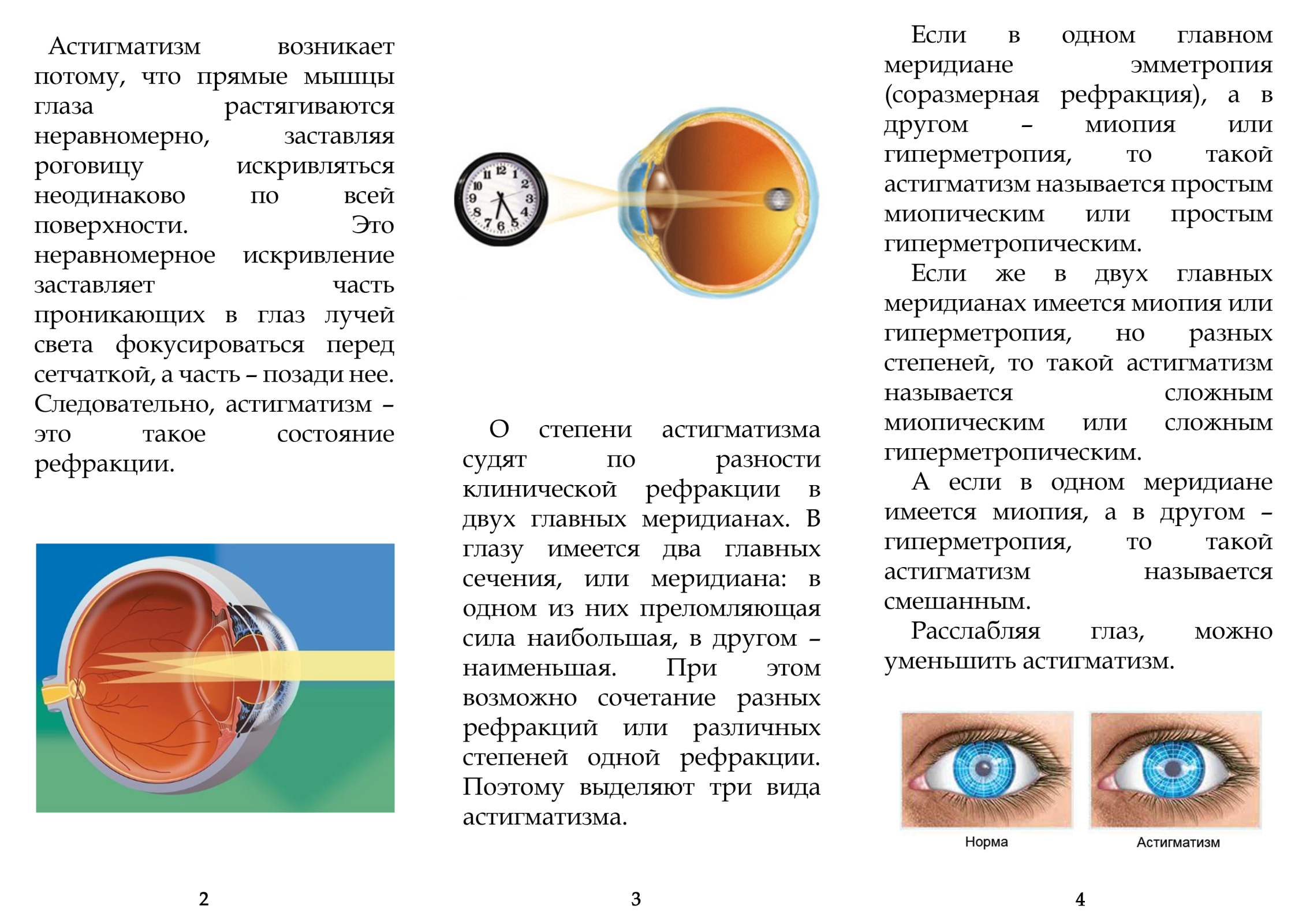 Миопический астигматизм: виды (простой, сложный), причины, лечение близорукого астигматизма обоих глаз