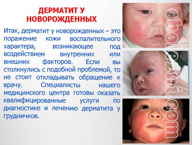 Перианальный дерматит у ребенка лечение