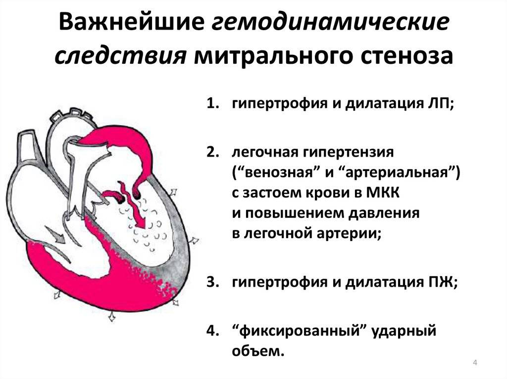 Митрально-аортальный стеноз, признаки, симптомы, диагностика порока сердца