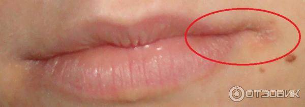 Трескаются уголки губ. причины, лечение, сохнут по бокам, в середине, шелушатся, каких витаминов не хватает