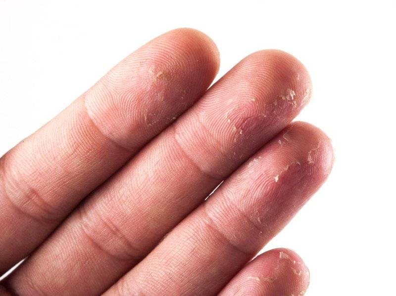 Возможные причины шелушения кожи, появления трещин на подушечках пальцев у детей