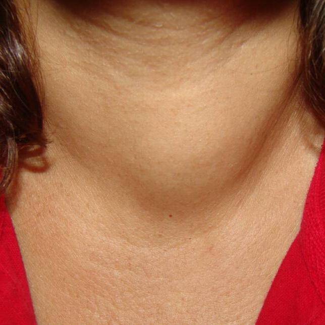 Щитовидная железа у мужчин: симптомы и лечение