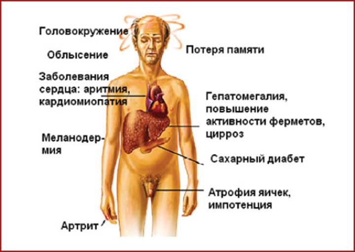 Цирроз печени у людей: симптомы, фото больных, как выглядит человек при заболевании