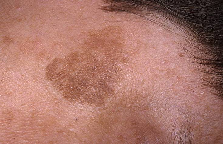 Старческая кератома мкб 10. кератоз кожи: фото, лечение, типы и виды