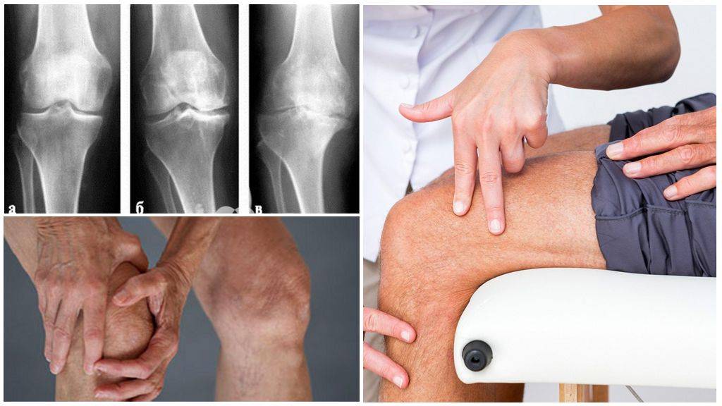Артроз коленного сустава 3 степени: лечение без операции, симптомы