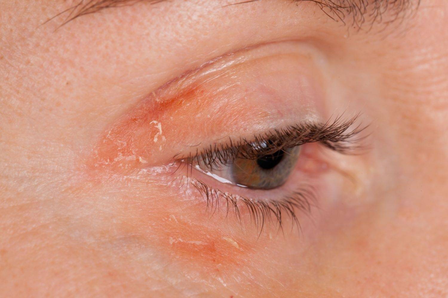 Симптомом каких болезней могут быть красные белки глаз у взрослого?