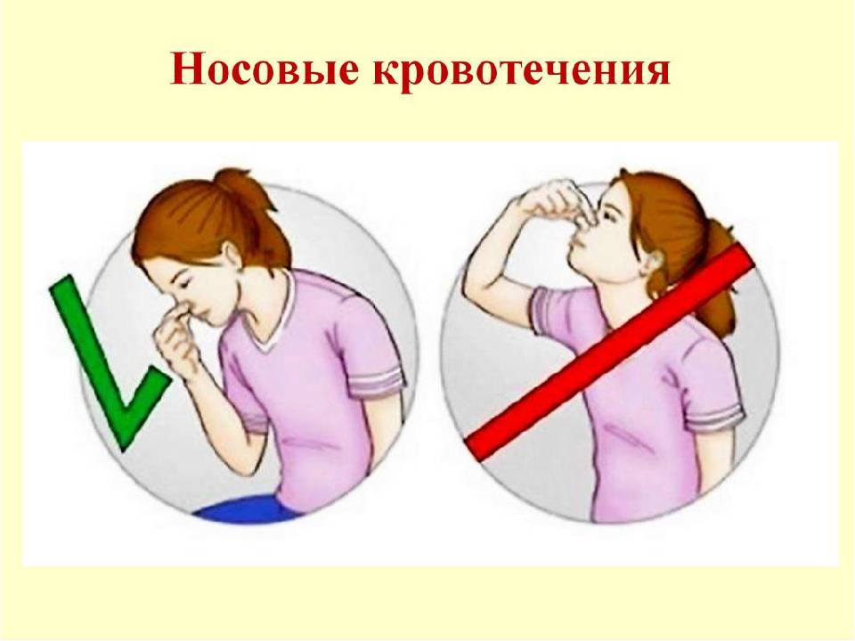 Остановить кровь из носа (11 советов ) — полезные советы