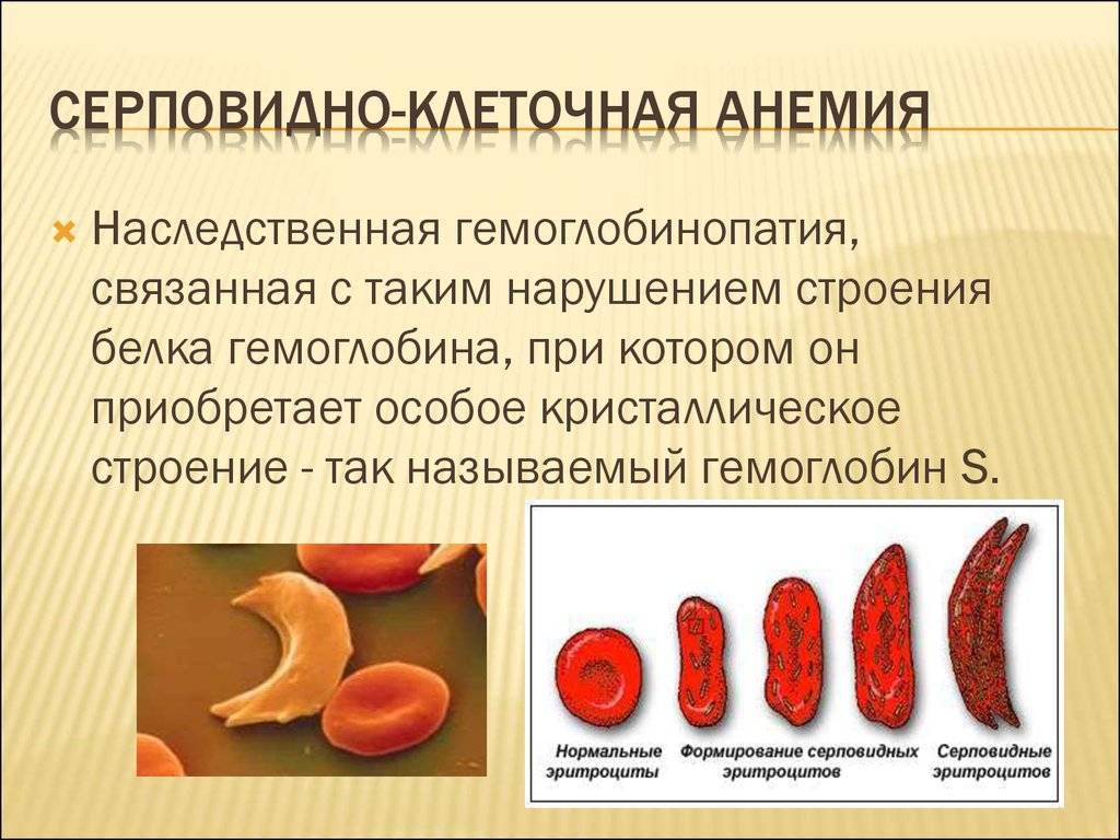 Серповидно-клеточная анемия, лечение, причины, симптомы,  профилактика.