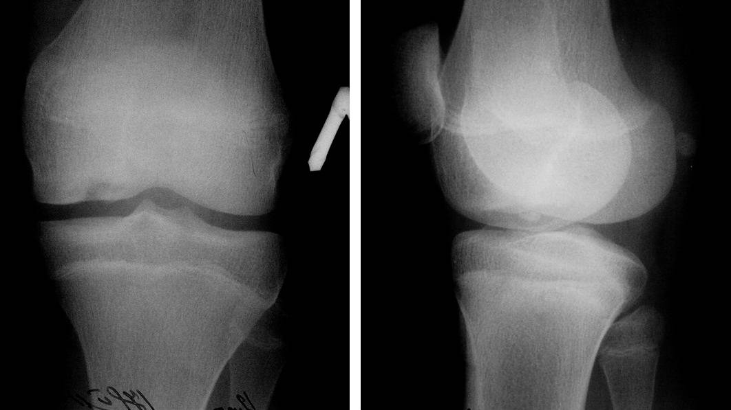 Болезнь кенига коленного сустава. что это такое, лечение, стадии у детей, спортсменов, взрослых, рентгенологическая картина, операция