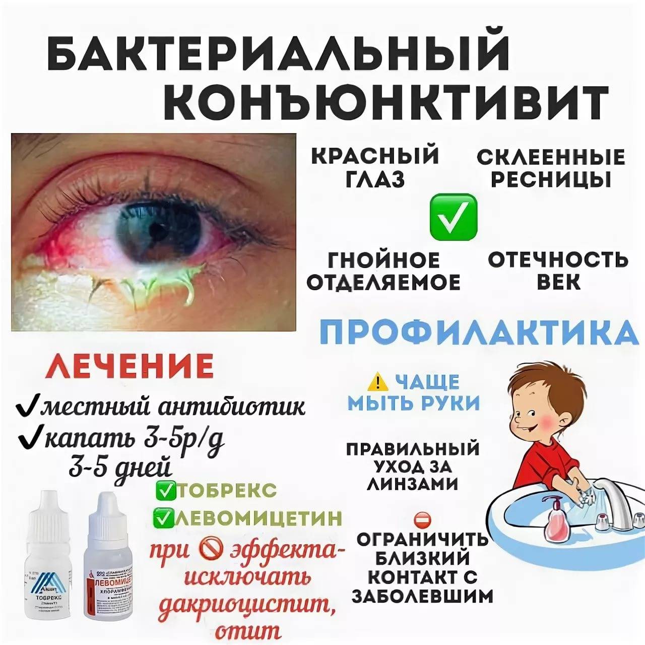 Глаза после прививки. Коньюктивит вирусный конъюнктивит и бактериальный конъюнктивит. Симптомы при конъюнктивите. Конъюнктивит профилактика ц у детей. Профилактика конъюнктивита у детей.