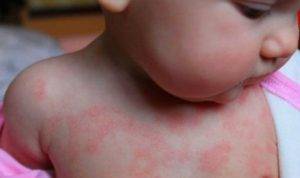 Аллергия на глютен. симптомы у взрослых, как проявляется, анализы, лечение, что есть нельзя — medists.ru
