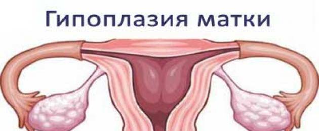 Гипоплазия матки: 10 причин, 3 симптома, 4 подхода к лечению, прогноз
