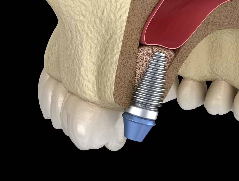 Имплант в гайморовой пазухе: причины, последствия | все об имплантации зубов