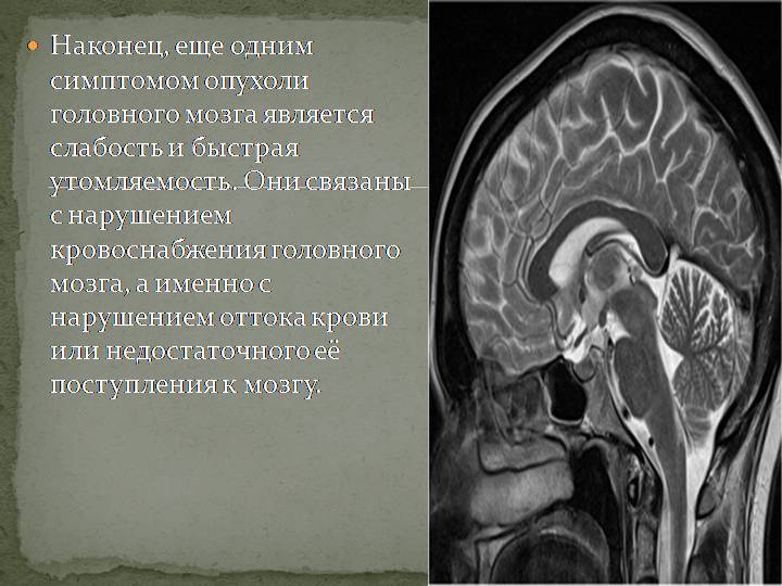 Симптомы онкологии головного мозга