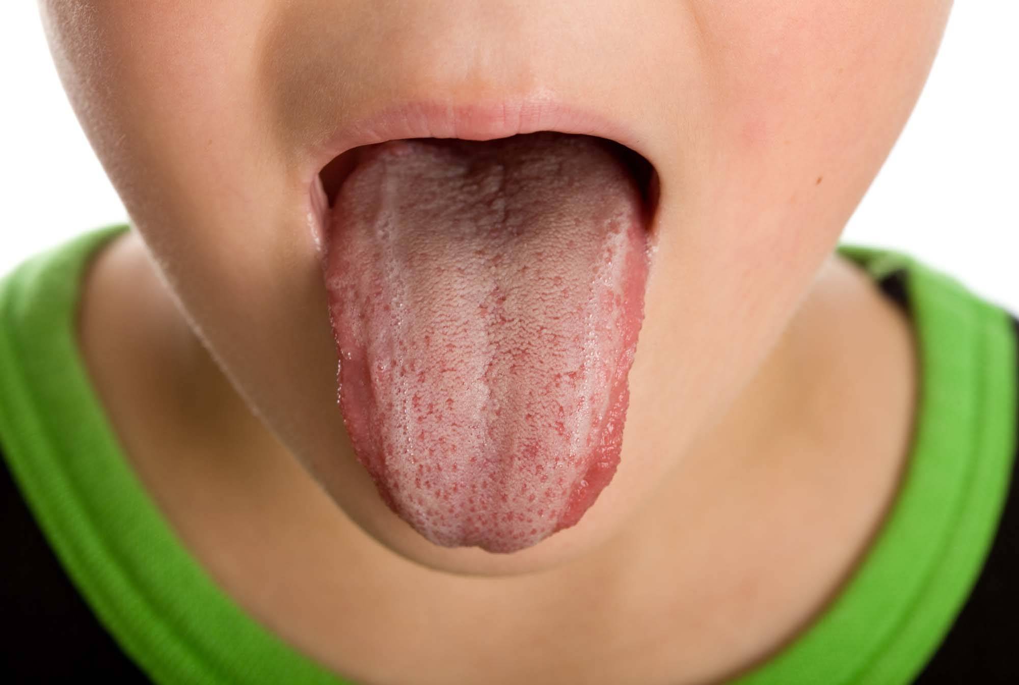 Белый налет на языке – когда нужно обращаться к врачу?