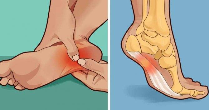Почему болят пятки ног: что делать и как их лечить?