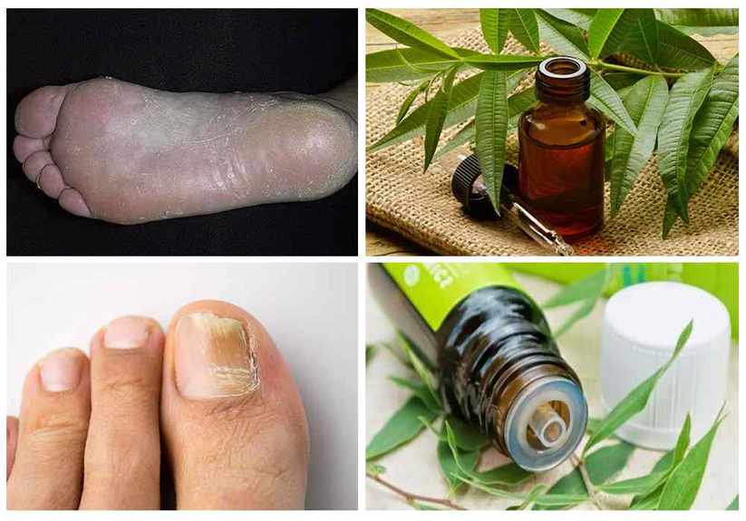 Народные средства лечения грибка ногтей на ногах - народные рецепты