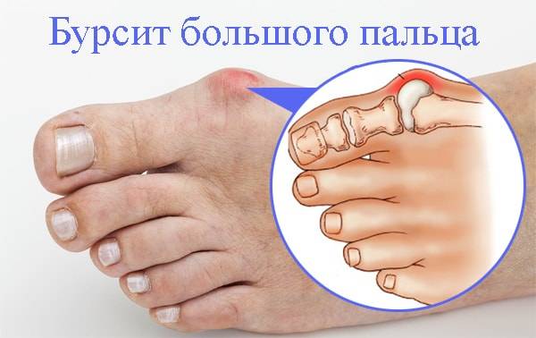 Болит сустав большого пальца на ноге: причины, лечение