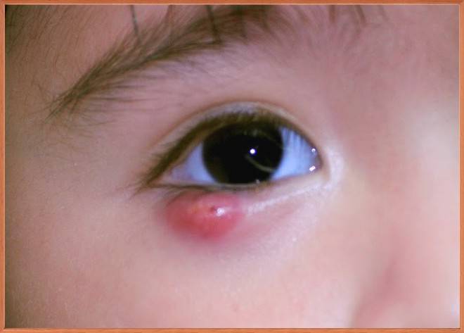 Ячмень на глазу у ребенка: как лечить, что делать, причины, симптомы, фото