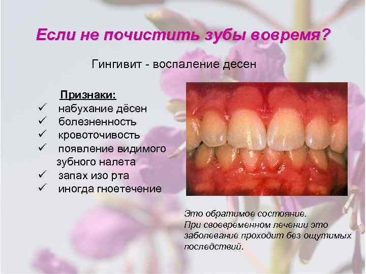 Почему может возникать запах изо рта после удаления зуба?