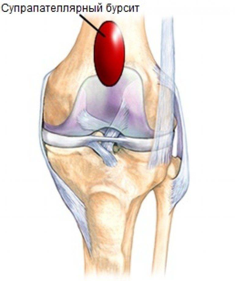 Препателлярный бурсит (коленного сустава): суть патологии, причины, лечение